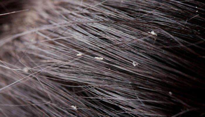 Natural Remedies to Treat Dandruff