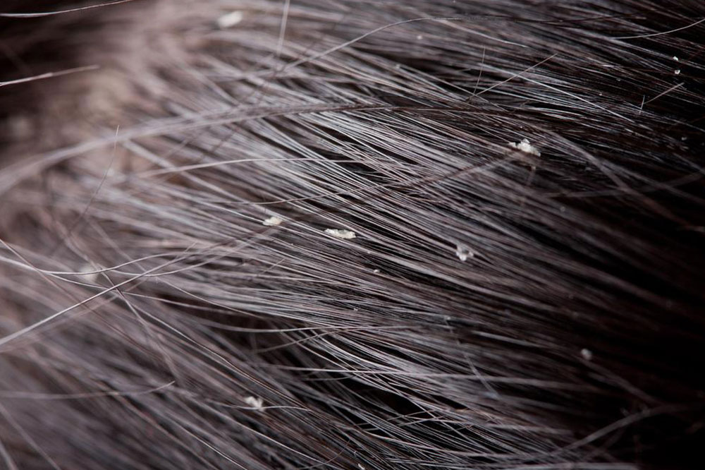 Natural Remedies to Treat Dandruff